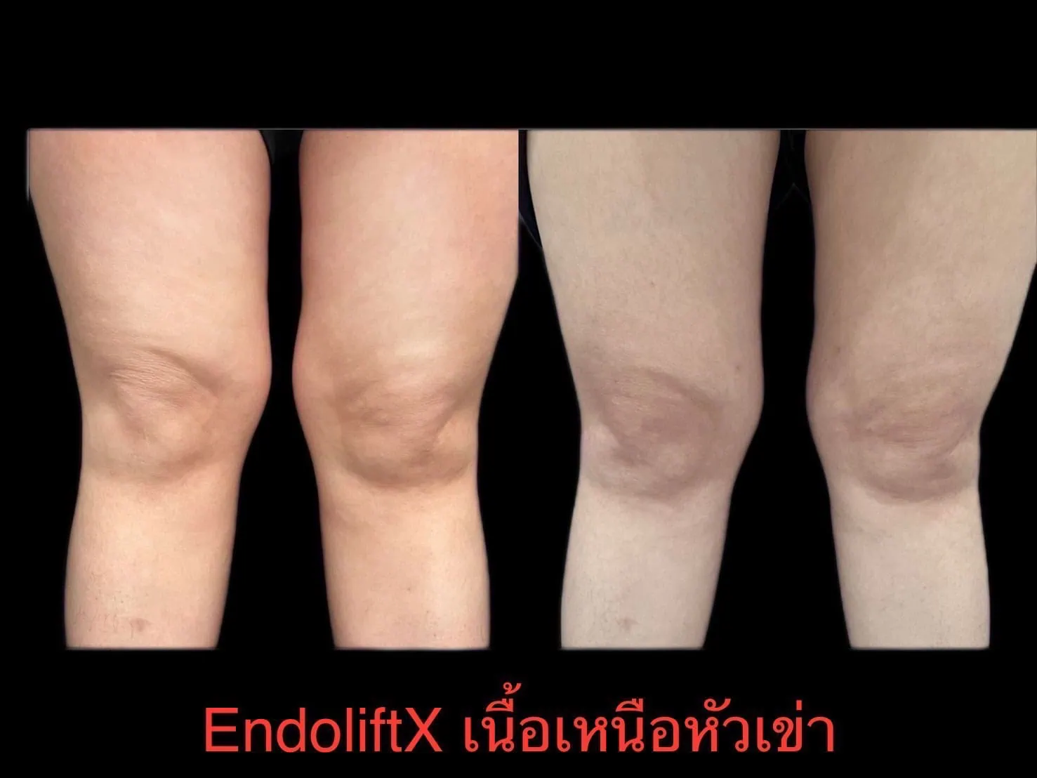 Treatment before and after