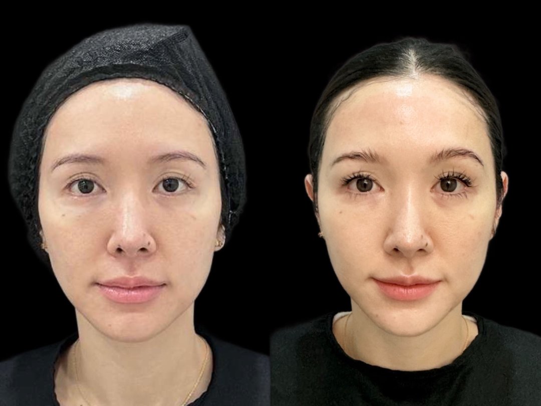EndoliftX result