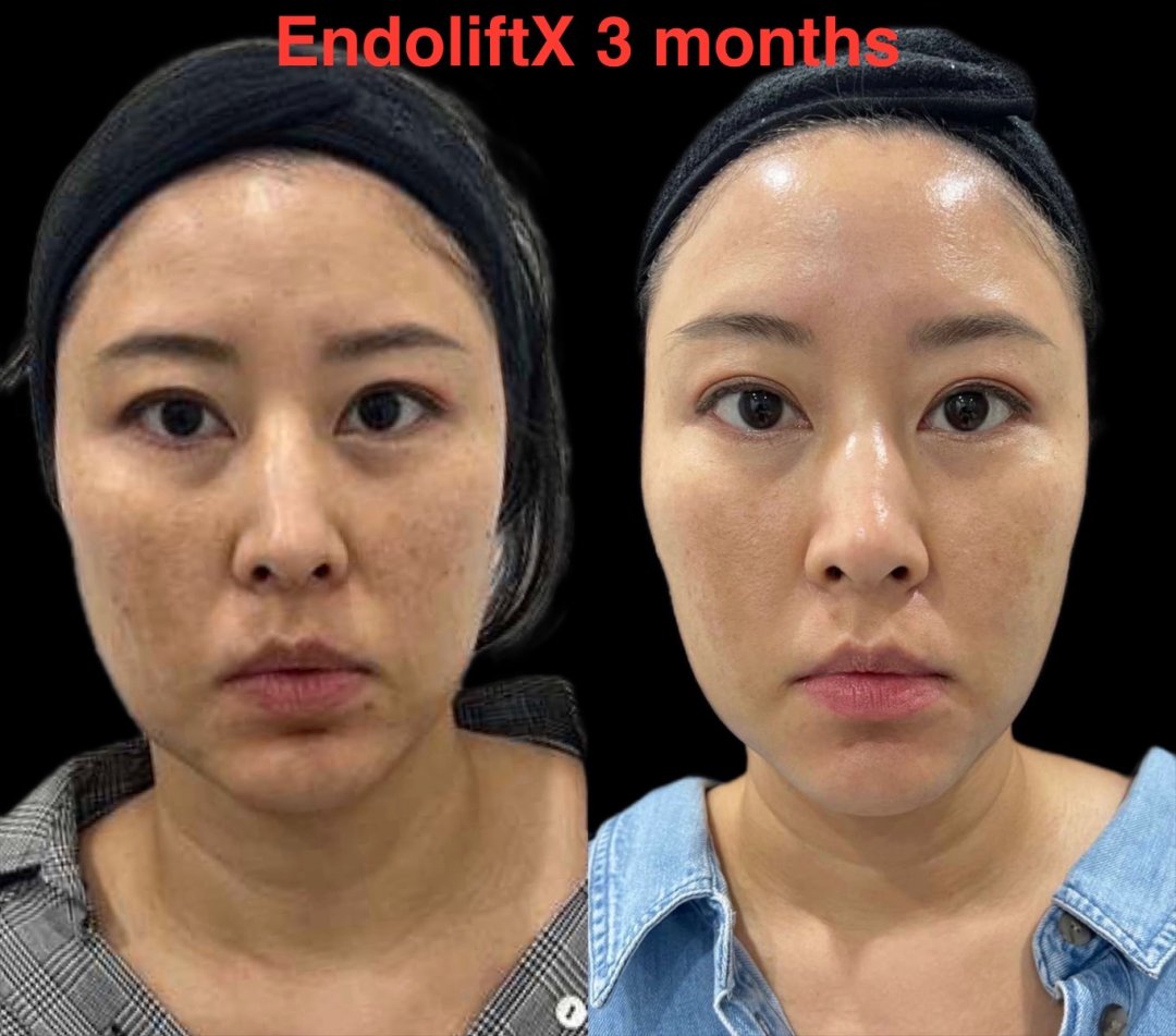EndoliftX before and after