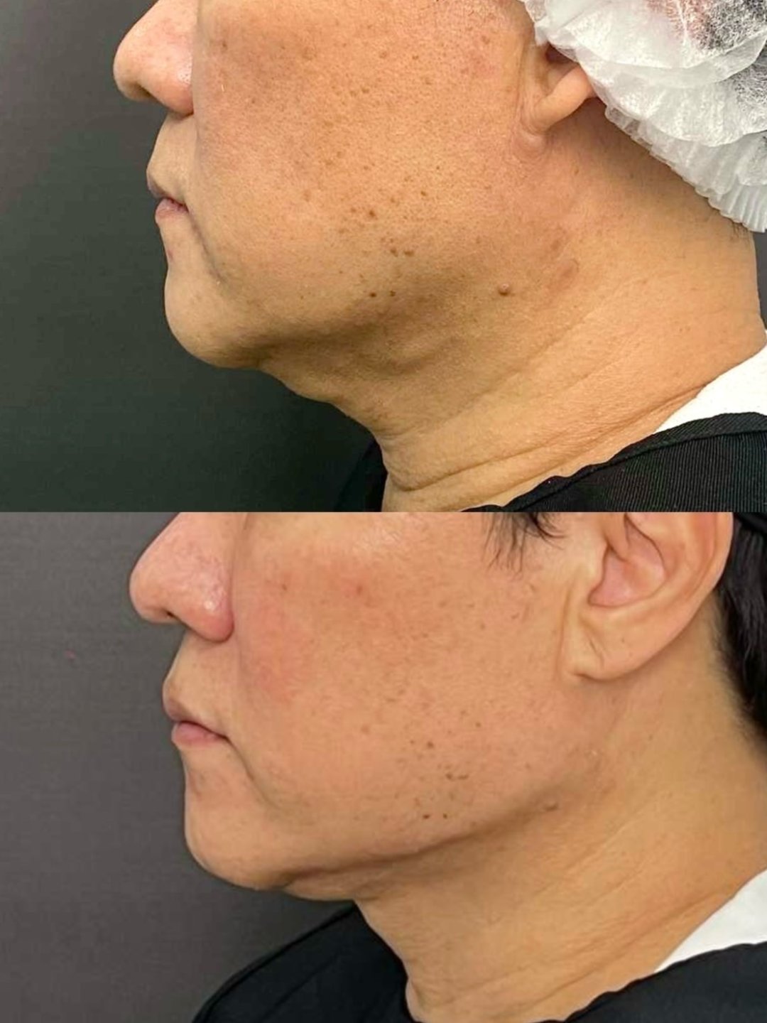 EndoliftX result
