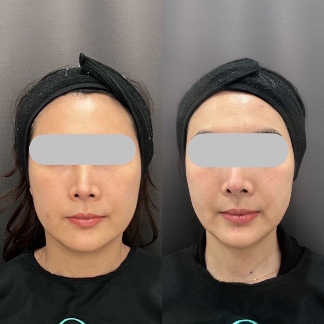 EndoliftX contour